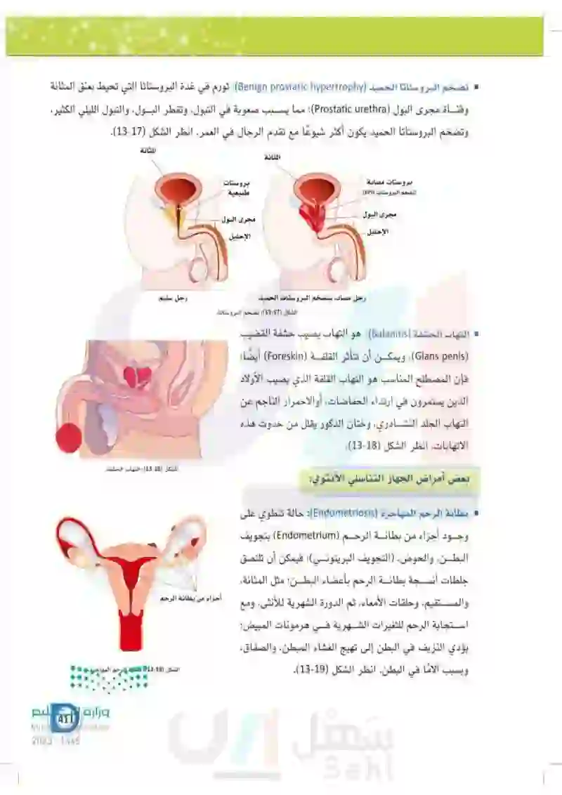 13-5 الأمراض الأكثر شيوعاً في الجهاز التناسلي